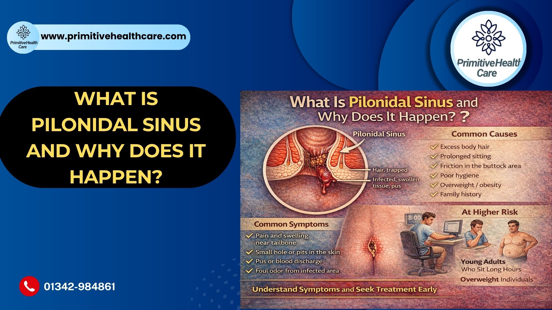 What Is Pilonidal Sinus and Why Does It Happen?